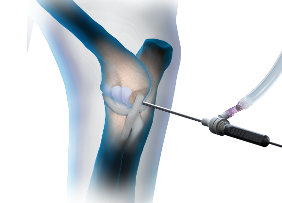 Arthrex - ApolloRF XL90, Aspirating Ablator 90°, Extra Large - AR-9821